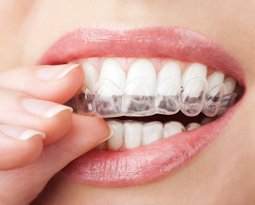 Transforming Smiles - The Complete Guide to Invisalign Before and