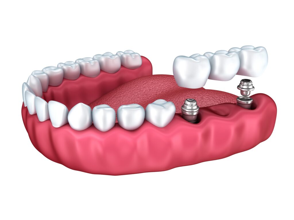 do-dental-implants-fall-out