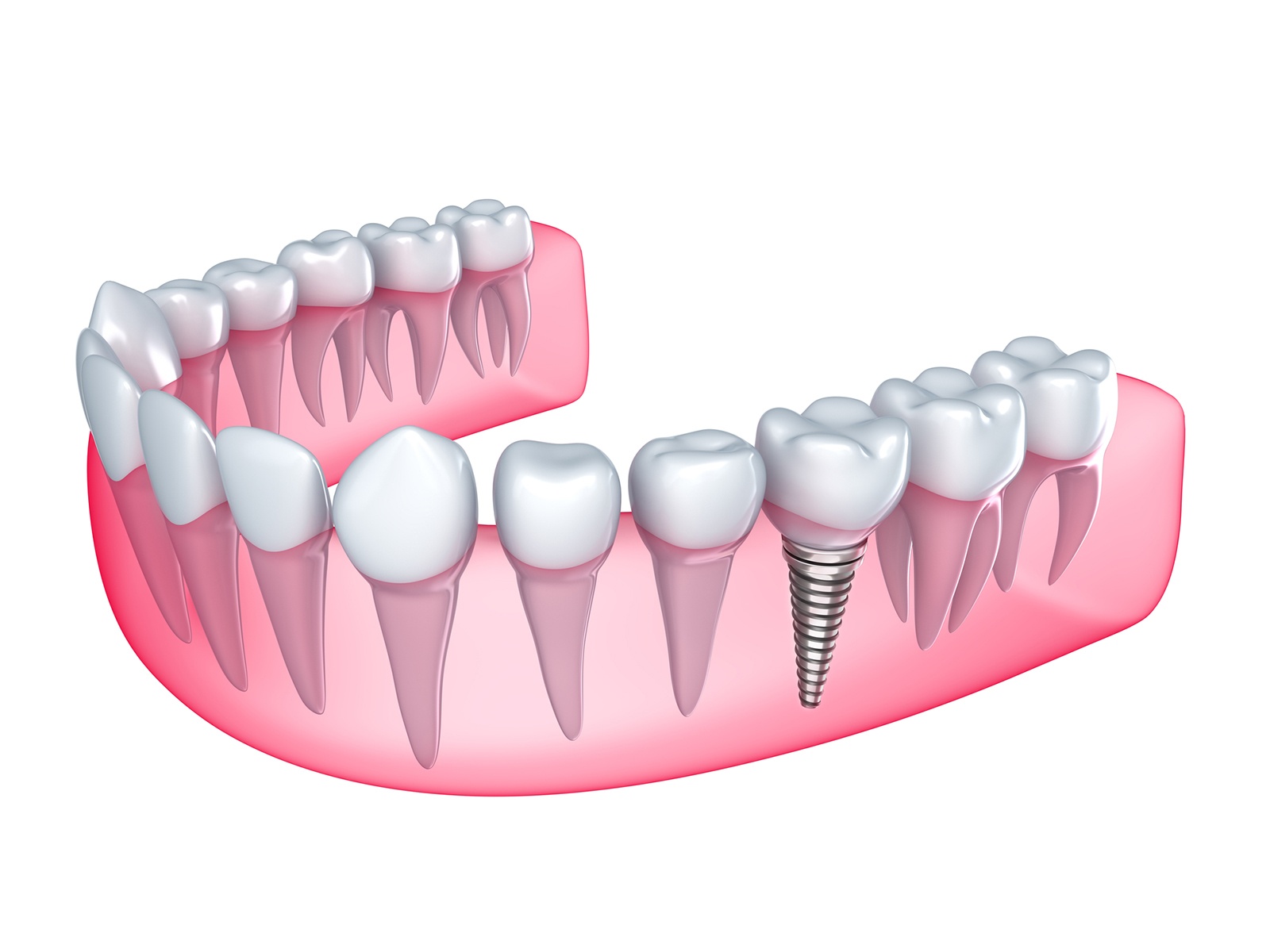 How Long After Dental Implants Can I Eat Normally 