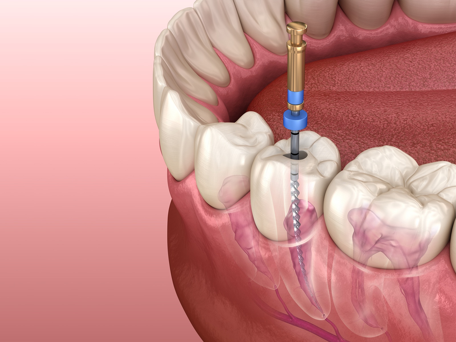 Can Nerves Grow Back After Root Canal 