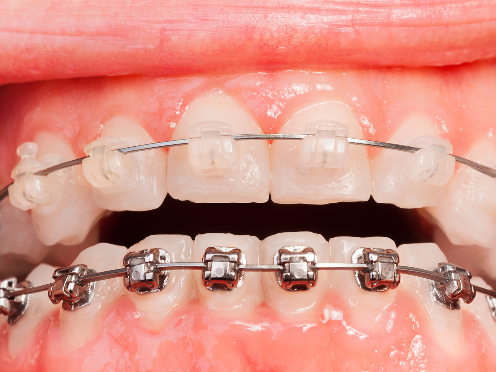 Clear Braces And Aligners: Benefits of Clear Braces - PerkinsOrtho