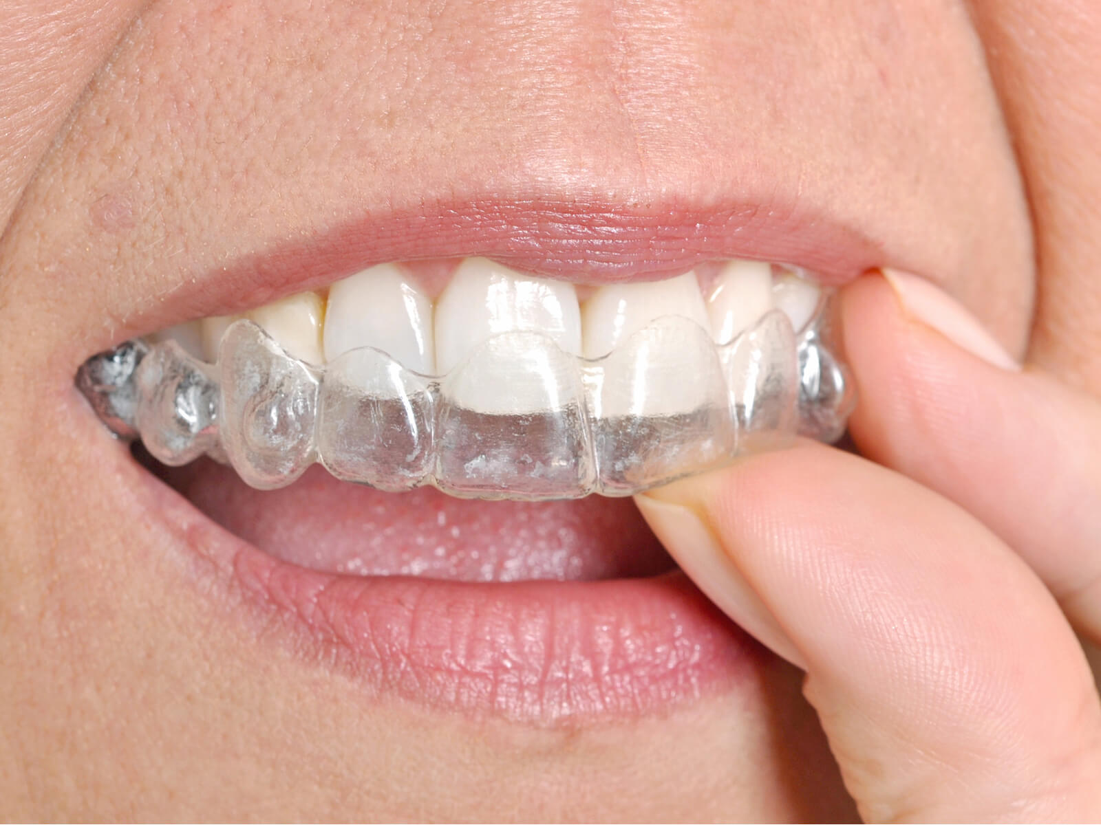 Invisalign And Gum Recession: What You Need To Know