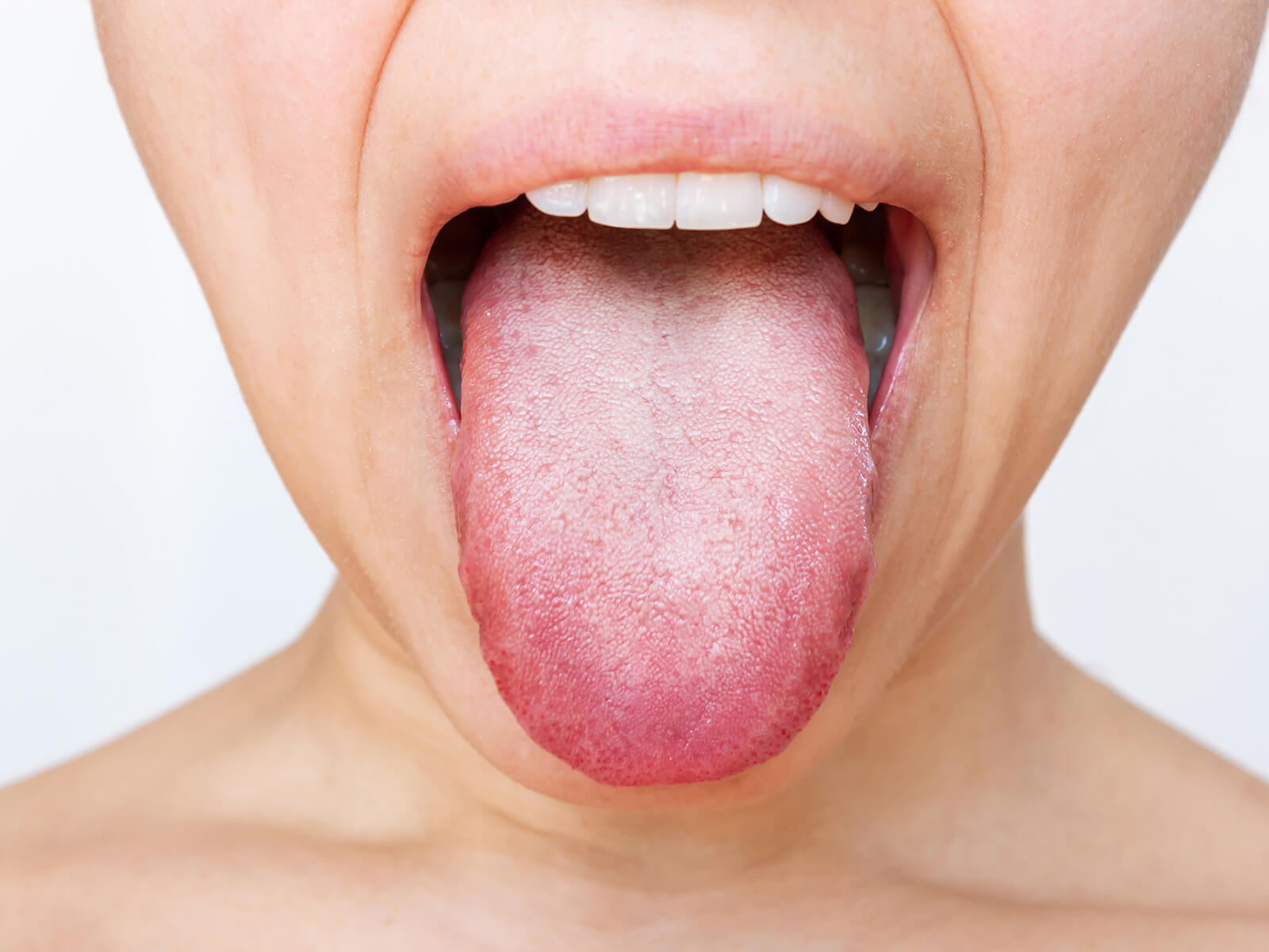 Preventing White Tongue: Daily Oral Care Tips