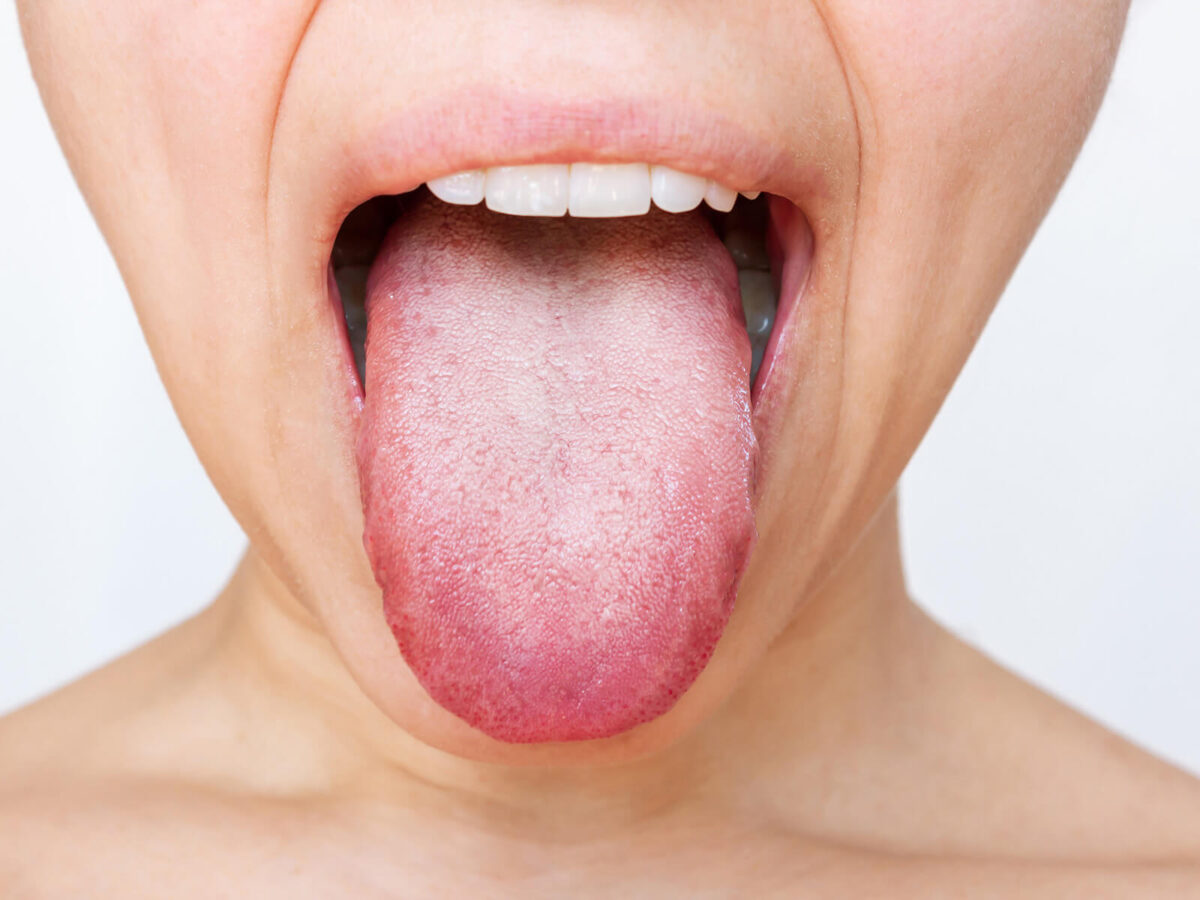 Causes of A White Tongue And How To Get Rid of It