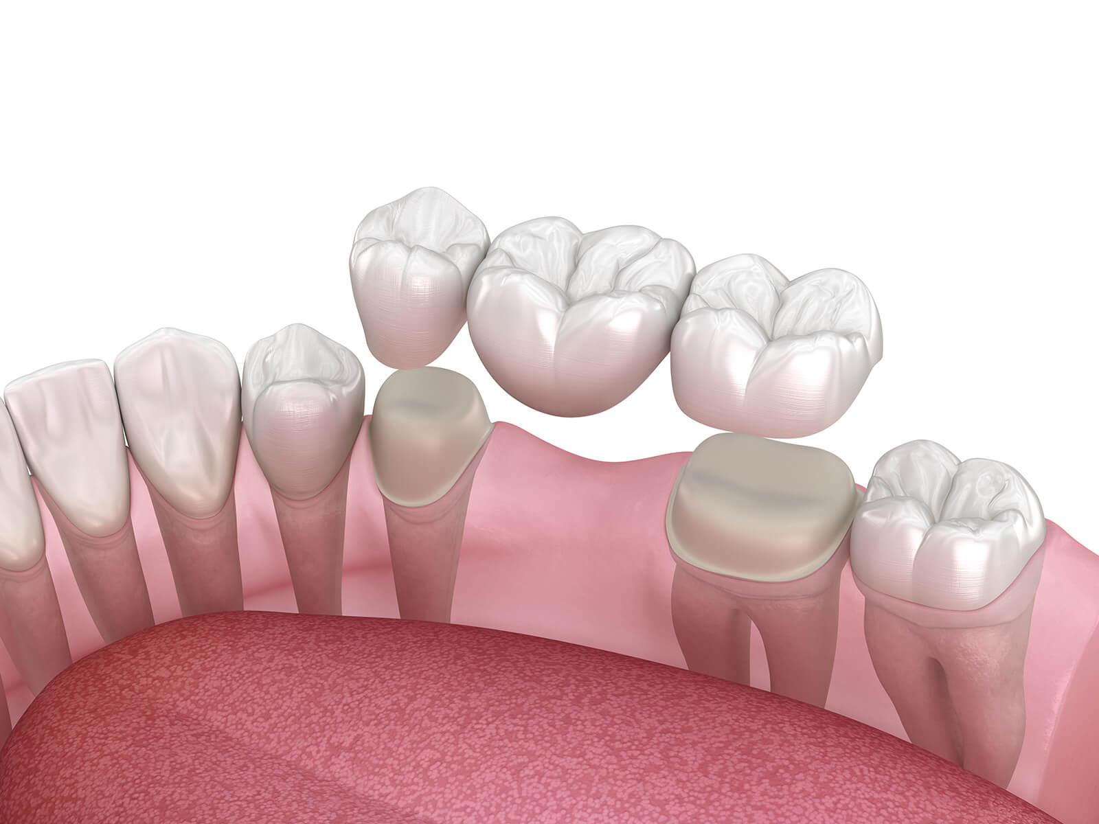 Top 5 Benefits of Porcelain Bridges For Dental Restoration