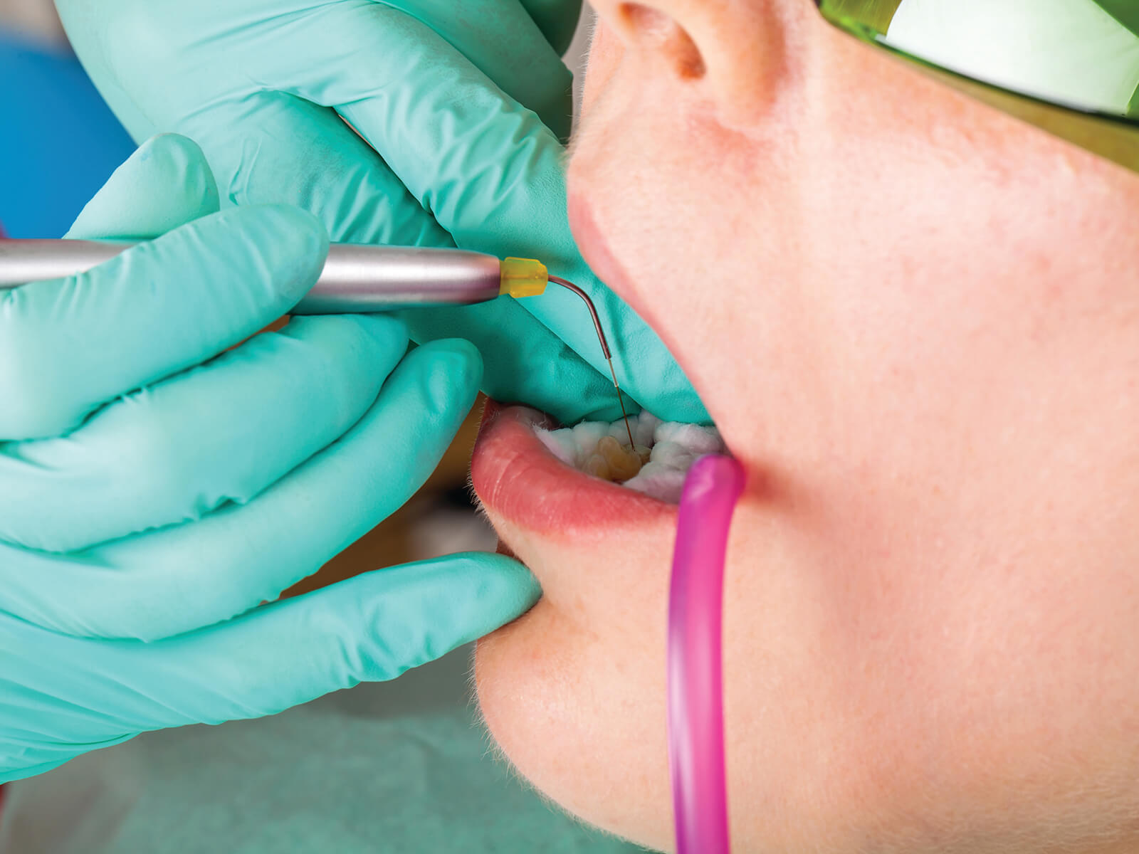 Understanding Laser Gum Therapy And Signs You Need It