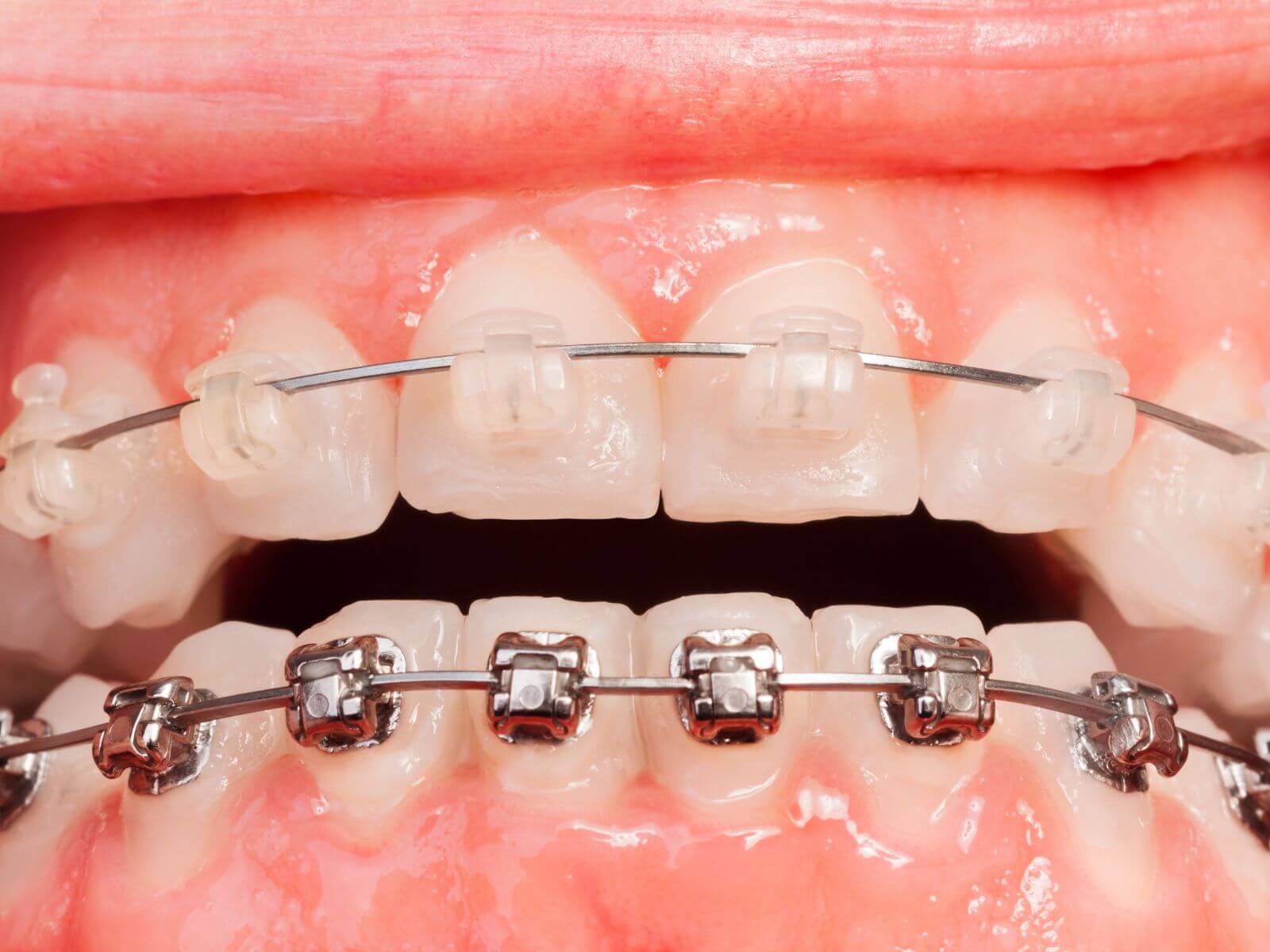 Why You Still Need Dental Cleanings During Braces