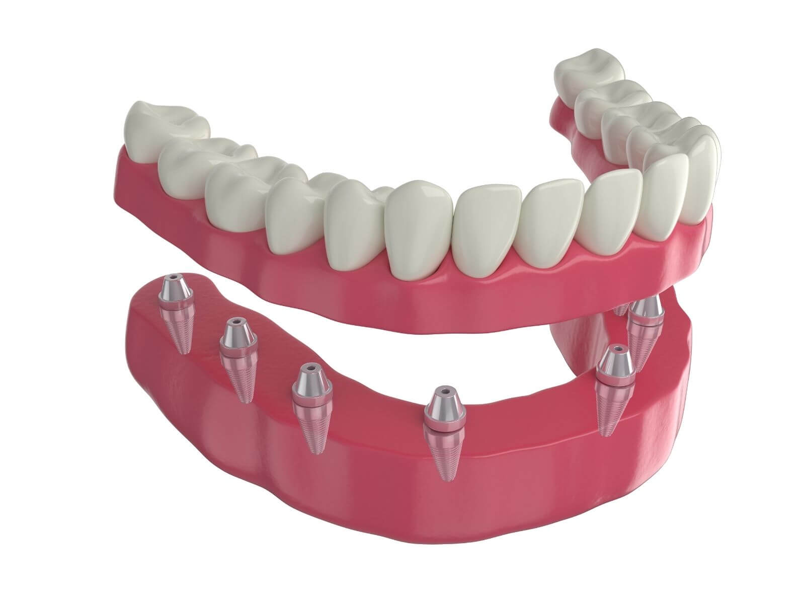 The Transformative Effects of Dental Implants